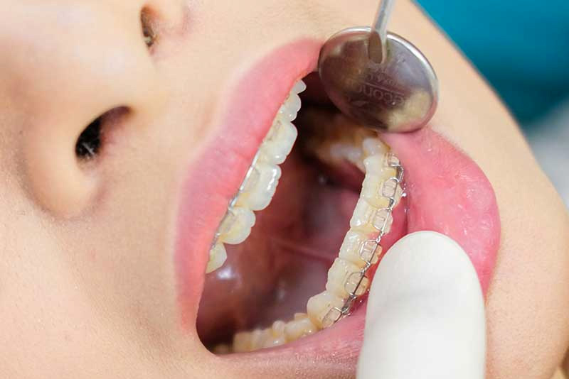 Bệnh nhân cần hiểu về quy trình niềng 2 răng cửa bị hô