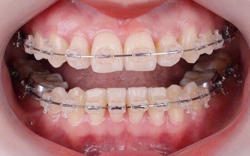 Bệnh nhân nên điều trị sớm nếu không sẽ ảnh hưởng đến răng miệng