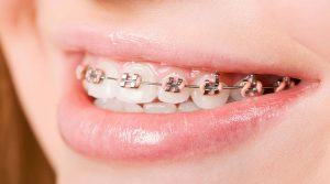 Có 2 loại khí cụ phổ biến để bệnh nhân có thể niềng răng