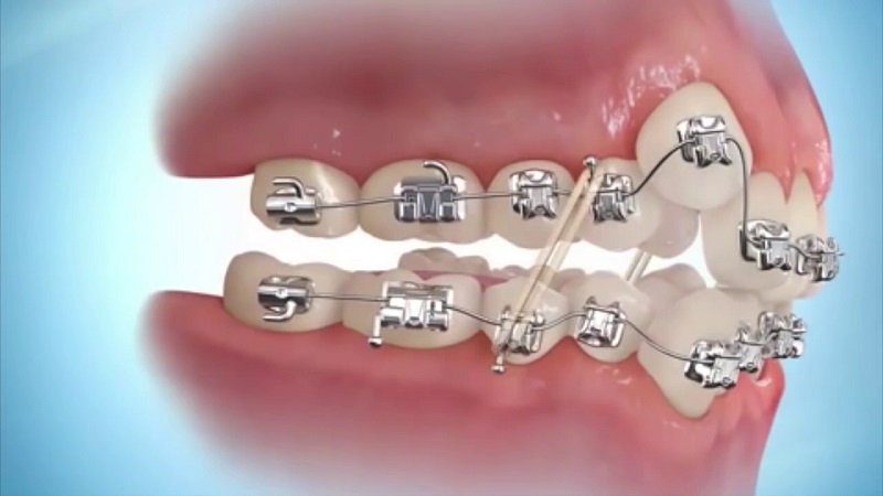 Tình trạng răng miệng hiện tại ảnh hưởng đến chi phí niềng răng 2 hàm