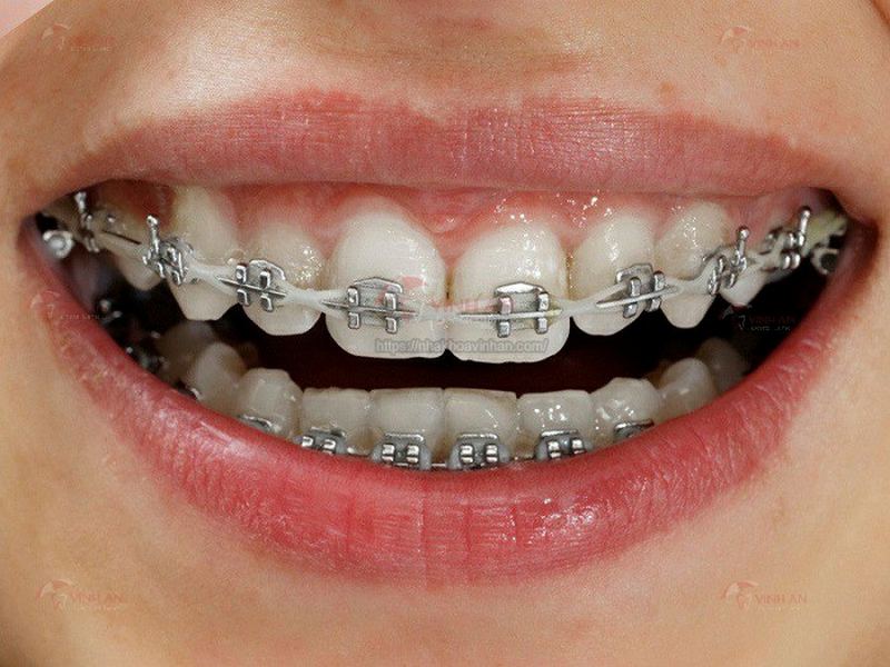 Chi phí niềng răng 2 hàm mắc cài kim loại là thấp nhất