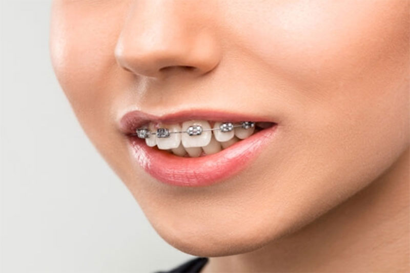 Quá trình niềng răng 1 hàm có những ưu điểm nhất định