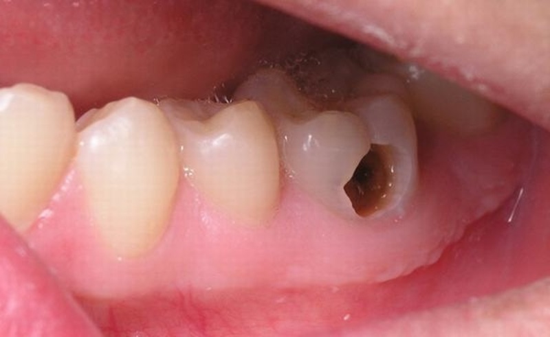 Sâu răng thường diễn ra theo 4 giai đoạn