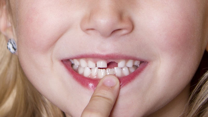 Vai trò của răng sữa đối với sự phát triển của trẻ