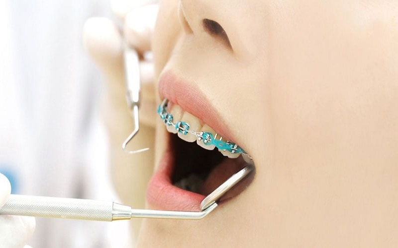 Niềng hai răng cửa bị hô tùy thuộc vào tình trạng răng miệng của bệnh nhân