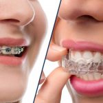 Bạn có thể lựa chọn giữa niềng răng mắc cài và niềng răng Invisalign khi điều trị răng hô
