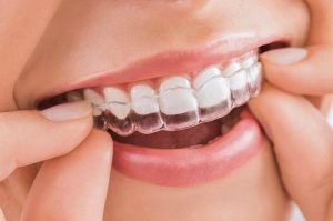Niềng răng trong suốt Invisalign là phương pháp hiện đại và đắt đỏ