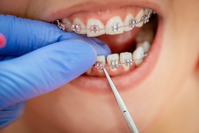 Việc niềng răng ở Bệnh viện Răng Hàm Mặt có những ưu nhược điểm khác nhau