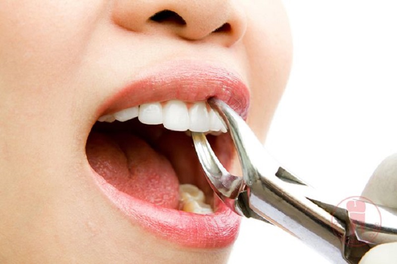 Việc có cần nhổ răng khi niềng răng hô hay không tùy thuộc vào tình trạng răng của bạn