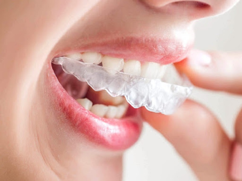 Chi phí cho từng loại niềng răng khác nhau tùy chọn vào tình trạng răng miệng