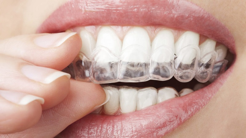 Niềng răng không có mắc cài được áp dụng khá phổ biến hiện nay