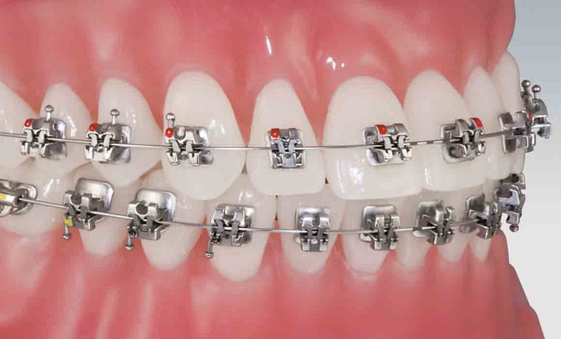 Hình thức niềng răng hô hàm có mắc cài kim loại