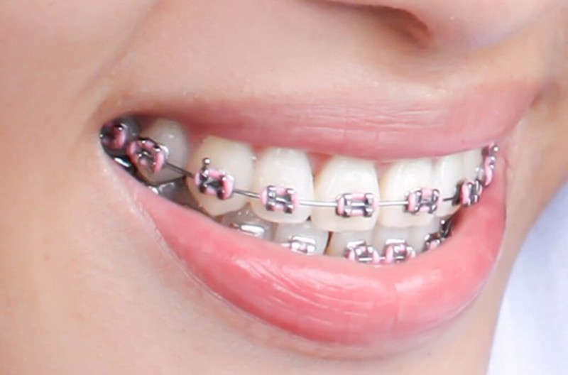 Niềng răng hô là phương pháp khắc phục tình trạng răng miệng cho bệnh nhân