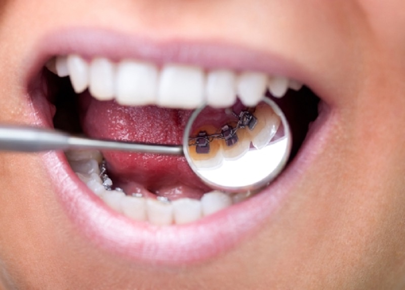 Niềng răng mắc cài mặt trong có thể sử dụng trong nhiều trường hợp