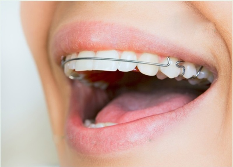 Quá trình niềng răng được tiến hành theo từng giai đoạn