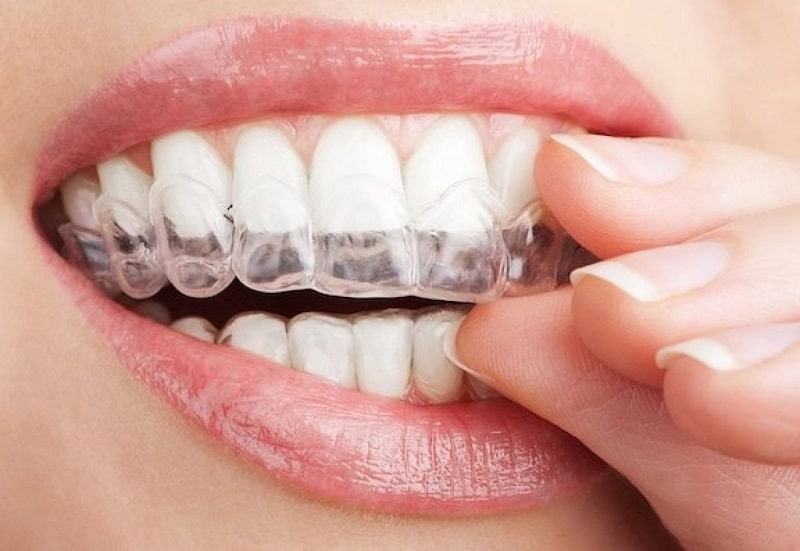 Chi phí niềng răng Invisalign phụ thuộc vào mức độ nghiêm trọng của răng miệng