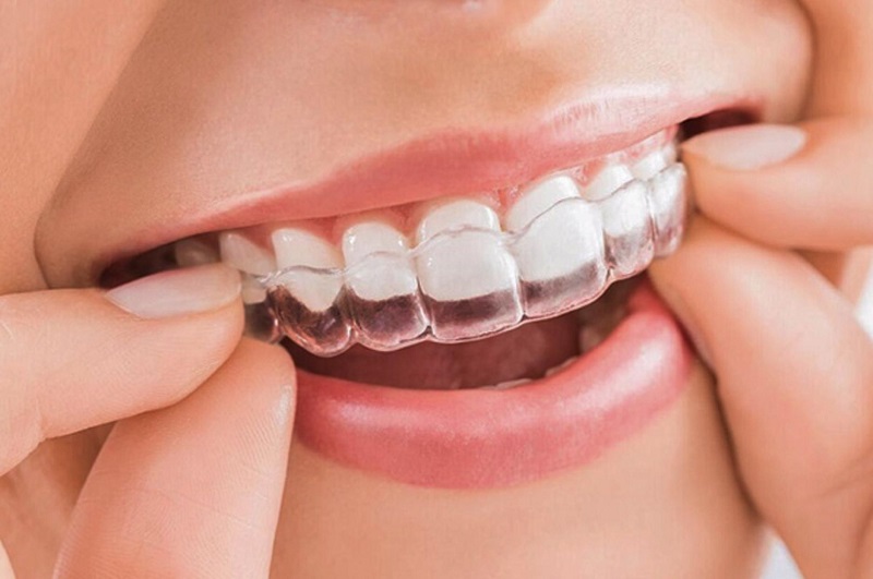 Hình ảnh khách hàng sử dụng phương pháp niềng răng vô hình Invisalign