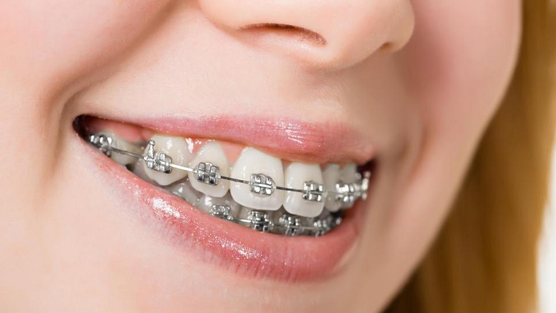 Hiện nay có rất nhiều phương pháp niềng răng hàm móm khác nhau.