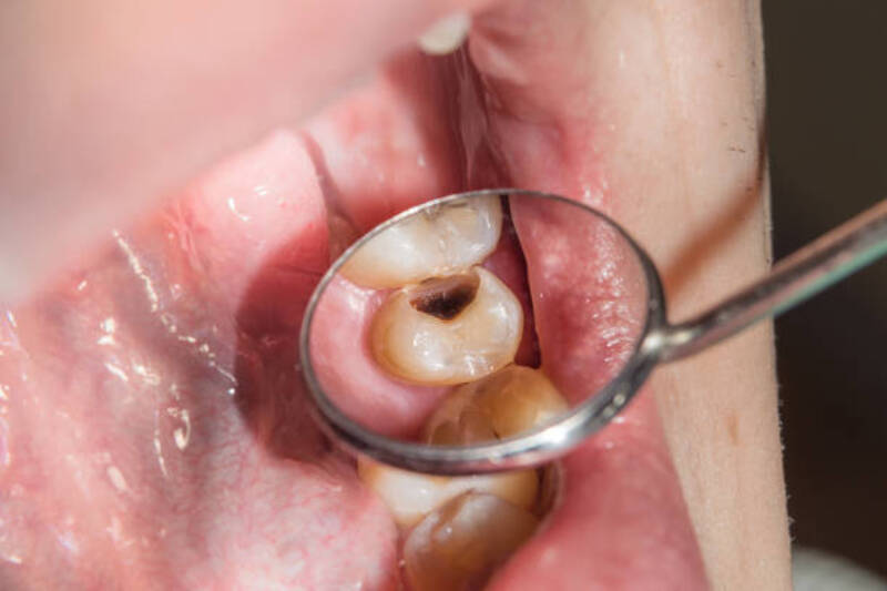 Có rất nhiều nguyên nhân dẫn đến tình trạng bị sâu răng