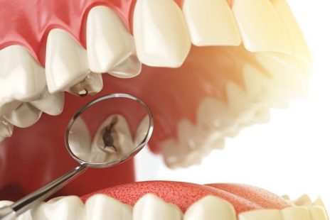 Sâu răng thường diễn ra theo 4 giai đoạn khác nhau