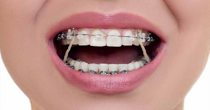 Thun niềng răng có nhiều loại với các công dụng khác nhau