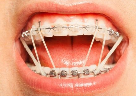 Những điều cơ bản về thun niềng răng trong chỉnh nha