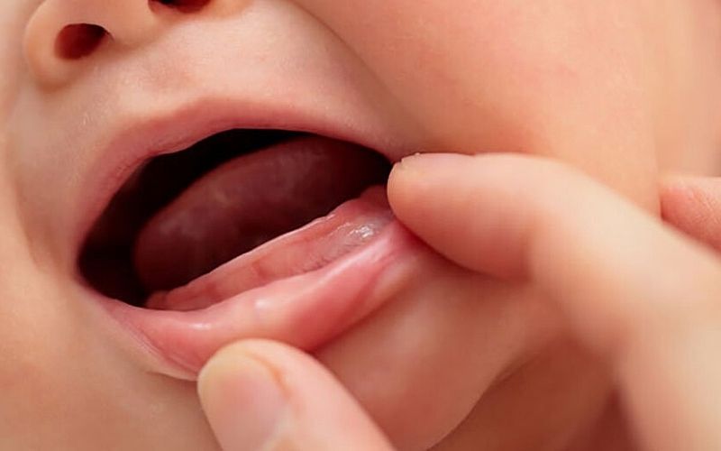 Nếu đến tháng thứ 12 - 13 không thấy sự phát triển của răng tức bé nhà bạn đang bị răng mọc chậm