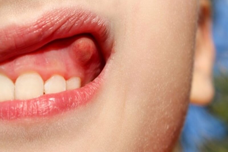 Áp xe nướu răng là tình trạng nhiễm trùng hình thành túi mủ trên răng