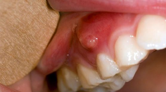 Áp xe nướu răng: nguyên nhân và cách điều trị