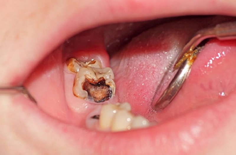 Sâu răng là thủ phạm của phần lớn các ca áp xe chóp