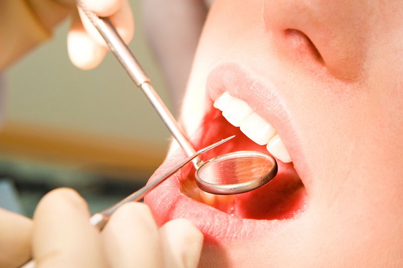 Lấy cao răng định kỳ là giải pháp hiệu quả giúp ngăn ngừa áp xe chóp