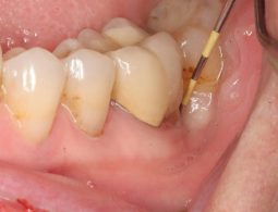 Áp xe quanh chóp răng: Nguyên nhân, triệu chứng và cách điều trị triệt để