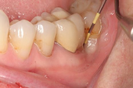 Áp xe quanh chóp răng: Nguyên nhân, triệu chứng và cách điều trị triệt để
