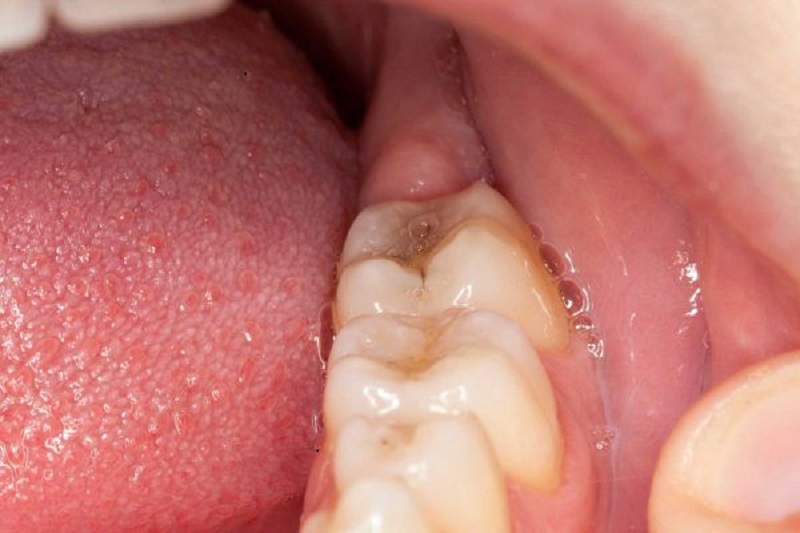 Áp xe răng khôn có thể đến từ tác động ngoại cảnh hoặc vấn đề vệ sinh răng miệng