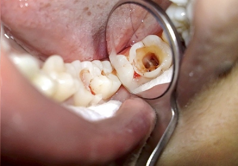 Sâu răng là nguyên nhân phổ biến dẫn đến tình trạng áp xe răng 7