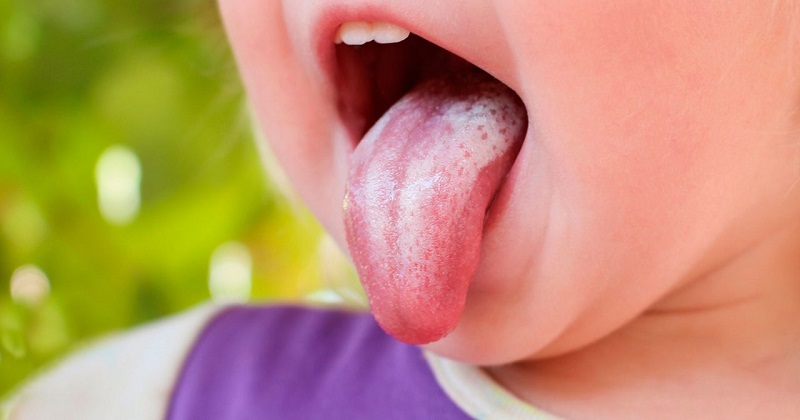 Nấm miệng hình thành bởi sự tích tụ các loại nấm Candida Albicans trên niêm mạc miệng.