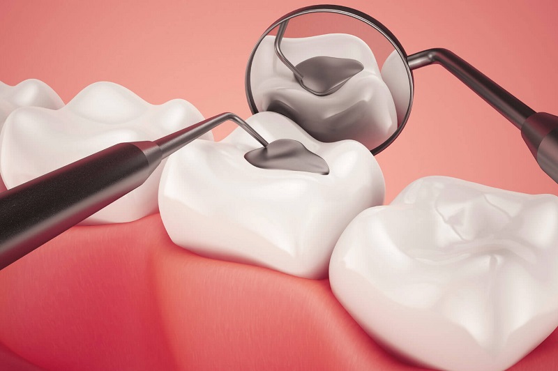 Trám răng là phương pháp điều trị sâu răng trẻ em phổ biến nhất