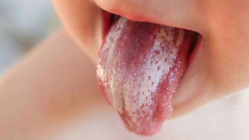 Nấm miệng là căn bệnh có khả năng lây lan cao.