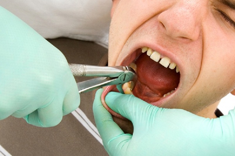 Ê buốt răng sau khi nhổ răng khôn có thể cảnh báo biến chứng của quá trình nhổ răng