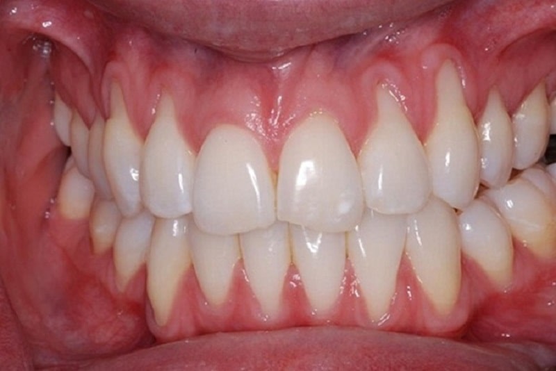 Nếu sử dụng hàm Trainer không đúng cách bạn có thể gặp tình trạng lộ chân răng, thậm chí là mất răng