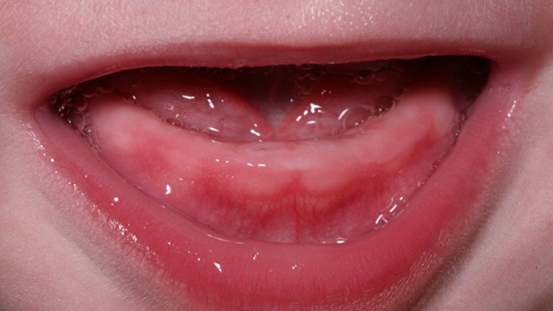 Chậm mọc răng chỉ tình trạng mọc răng sữa chậm ở trẻ nhỏ
