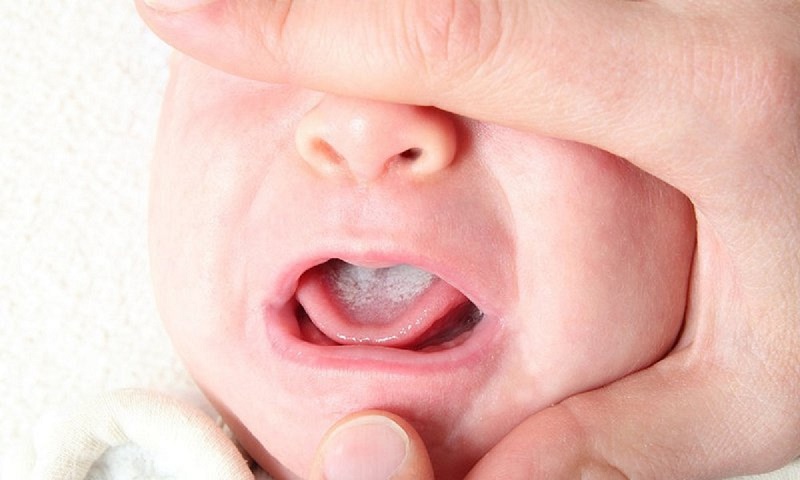 Nấm miệng ở trẻ em là tình trạng nhiễm khuẩn bên trong khoang miệng thường gặp.