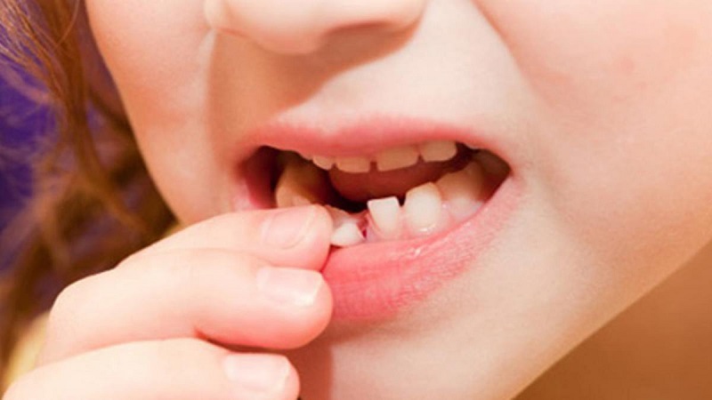 Nhổ răng sữa còn sót chân răng là tình trạng phổ biến xảy ra khi thực thiện tự nhổ tại nhà