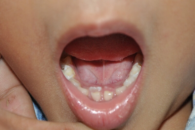 Nhiều cha mẹ nhầm răng mọc lẫy là răng thừa của bé