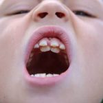 Răng trẻ mọc lẫy phải làm sao ?