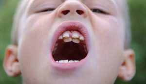 Răng trẻ mọc lẫy phải làm sao ?