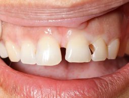 Bạn nên làm gì khi bị sâu răng cửa?