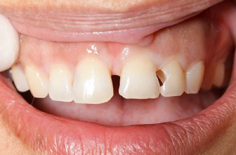 Bạn nên làm gì khi bị sâu răng cửa?