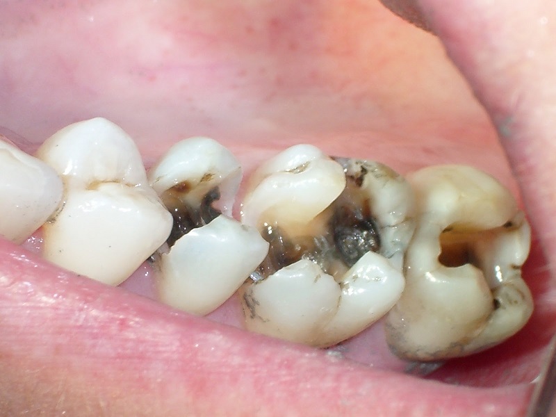 Sâu răng là thuật ngữ chỉ bệnh lý gây tổn thương mô cứng của răng