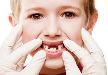 11 cách trị sâu răng cho bé tại nhà hiệu quả và an toàn